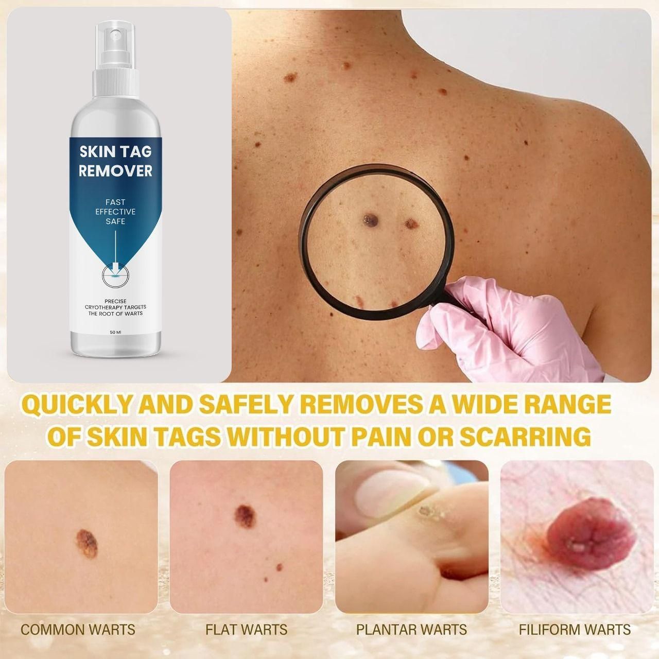 Skin Tag Remover 100 ml Pack of 2