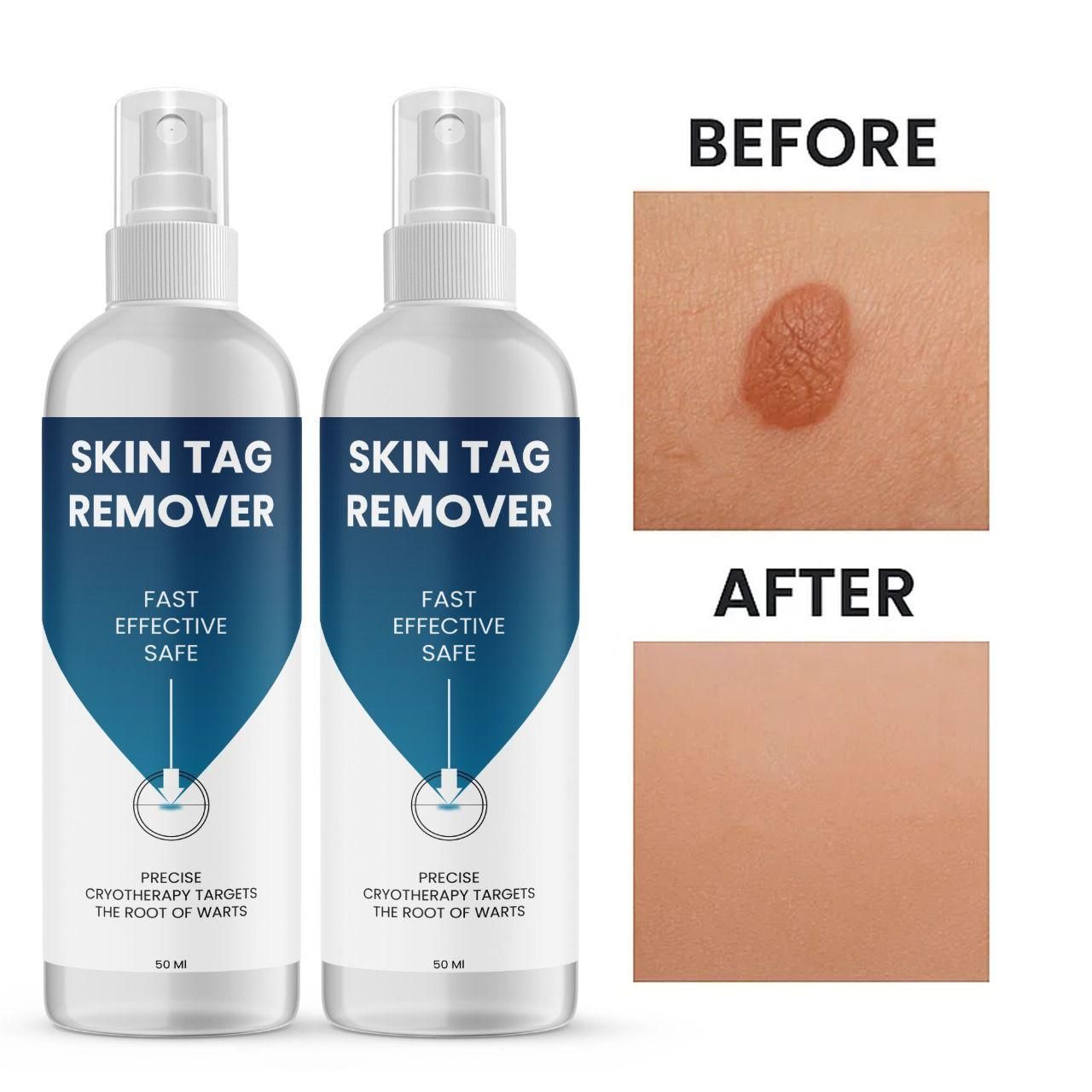 Skin Tag Remover 100 ml Pack of 2